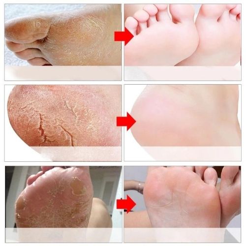 3x Foot Peel Mask Set – Exfoliating & Moisturizing Foot Treatment