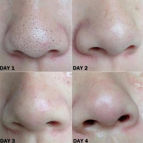 Nose Blackhead Remover Strips – Deep Pore Cleansing Charcoal Strips